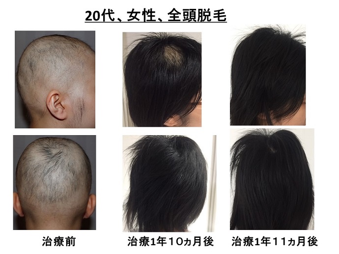 汎発性脱毛　病院